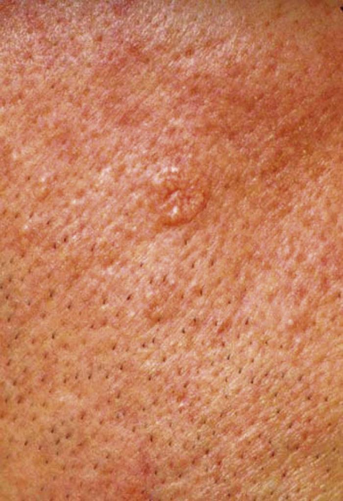 skin growth on face