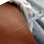 Hypertension
