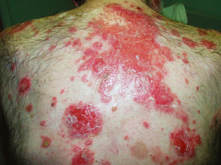 Clinical images: blistering