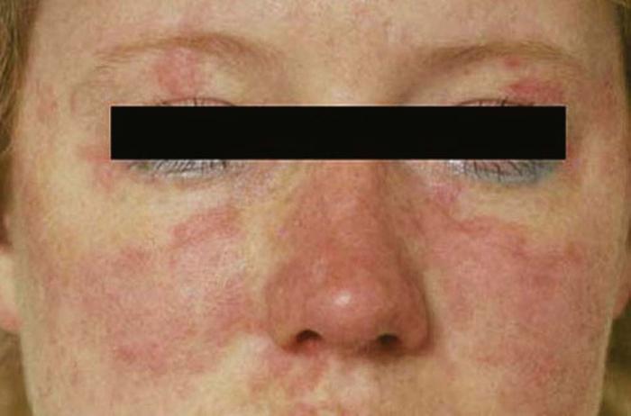 Clinical picture of Case 2 showing an erythematous scaly skin rash at