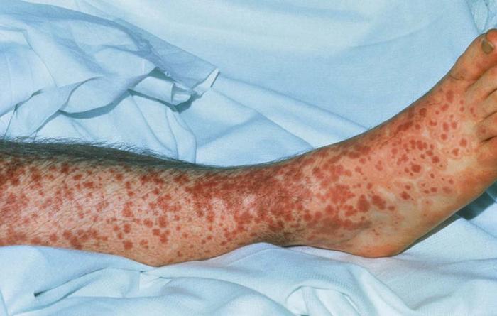 Dermatitis rash viral disease with immunodeficiency on body of