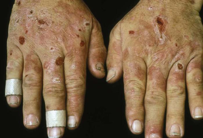 White Spots On Skin: 8 Dermatological Conditions, Causing ...
