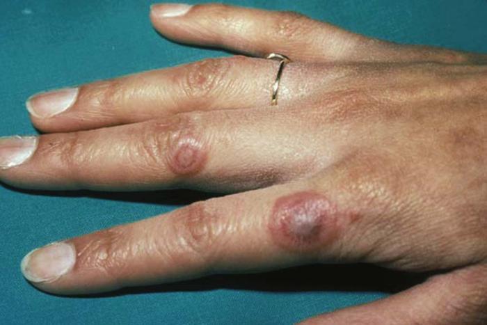 mild dermatitis herpetiformis on hands