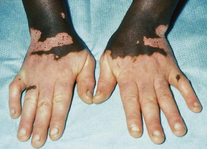 Scabies Rash Information and Guide - Healthy-Skin-Guide.com