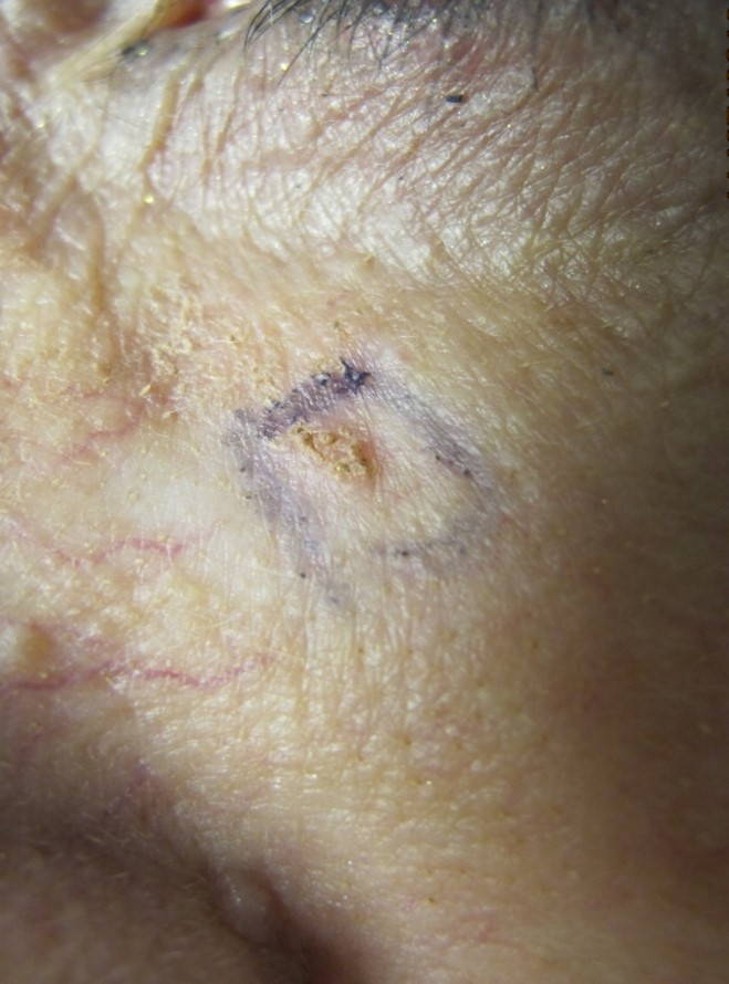 Firm lesion on the lateral thigh  Cleveland Clinic Journal of Medicine