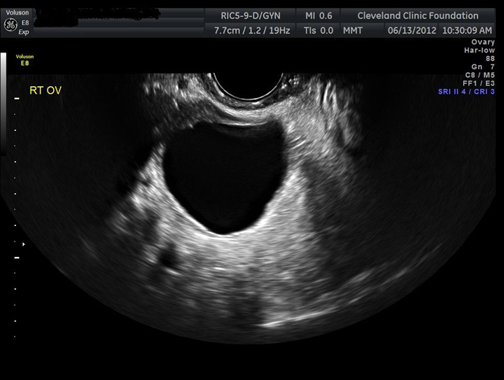 ruptured ovarian cyst