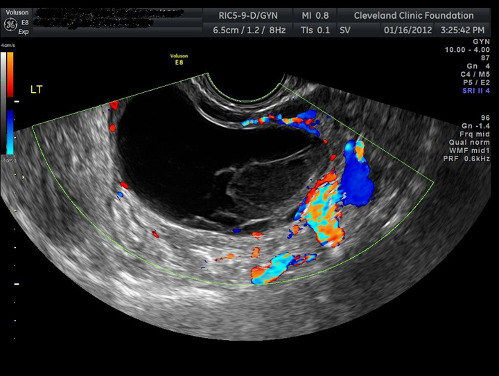 https://www.clevelandclinicmeded.com/medicalpubs/diseasemanagement/womens-health/ovarian-cysts/images/figure-2.jpg